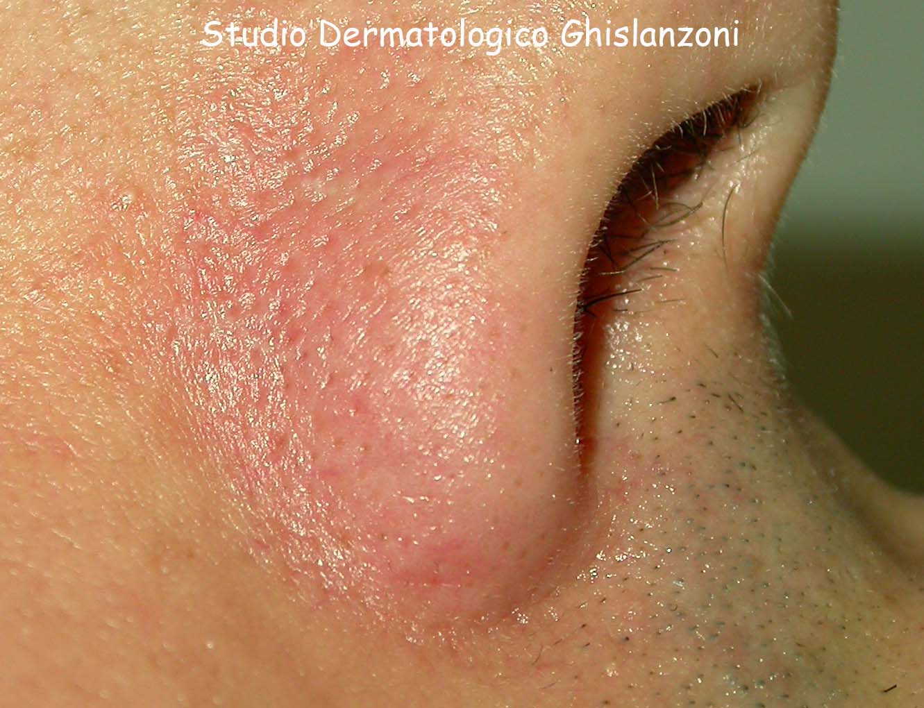 Capillari post laser