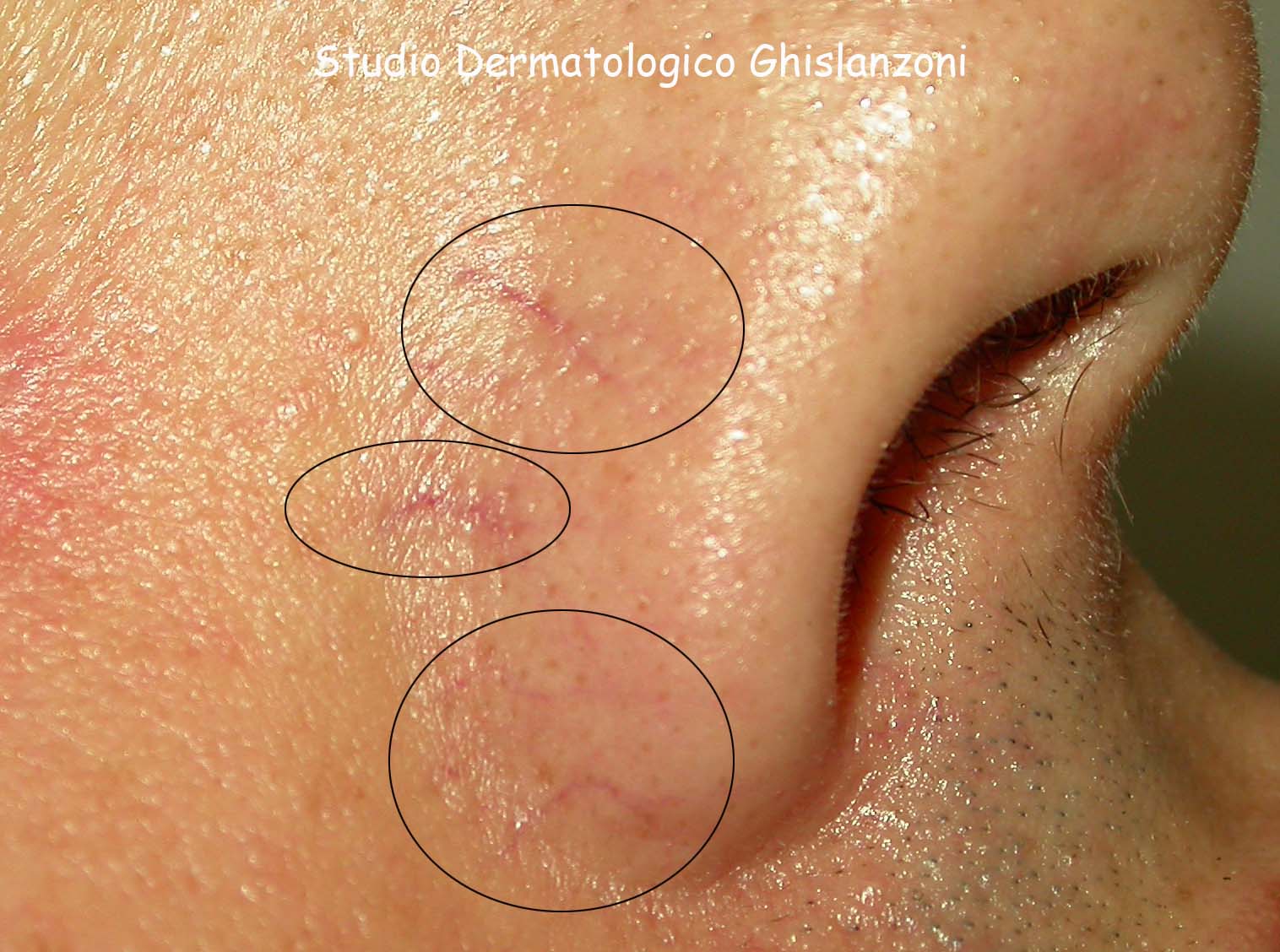 Capillari pre laser