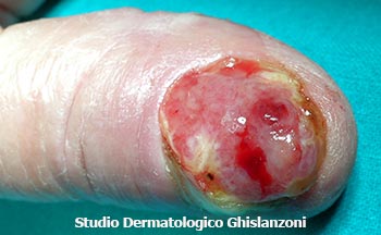 Melanoma_dellunghia.jpg