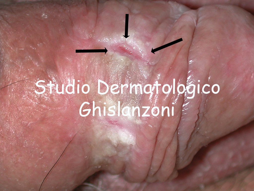 Liche sclero atrofico.jpg