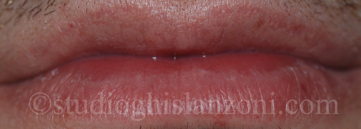 Ghiandole di Fordyce Labbra Ghiandole di Fordyce Labbra Volto min