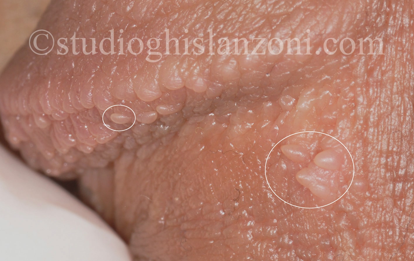 Papule perlacee del pene Papule perlacee del pene min