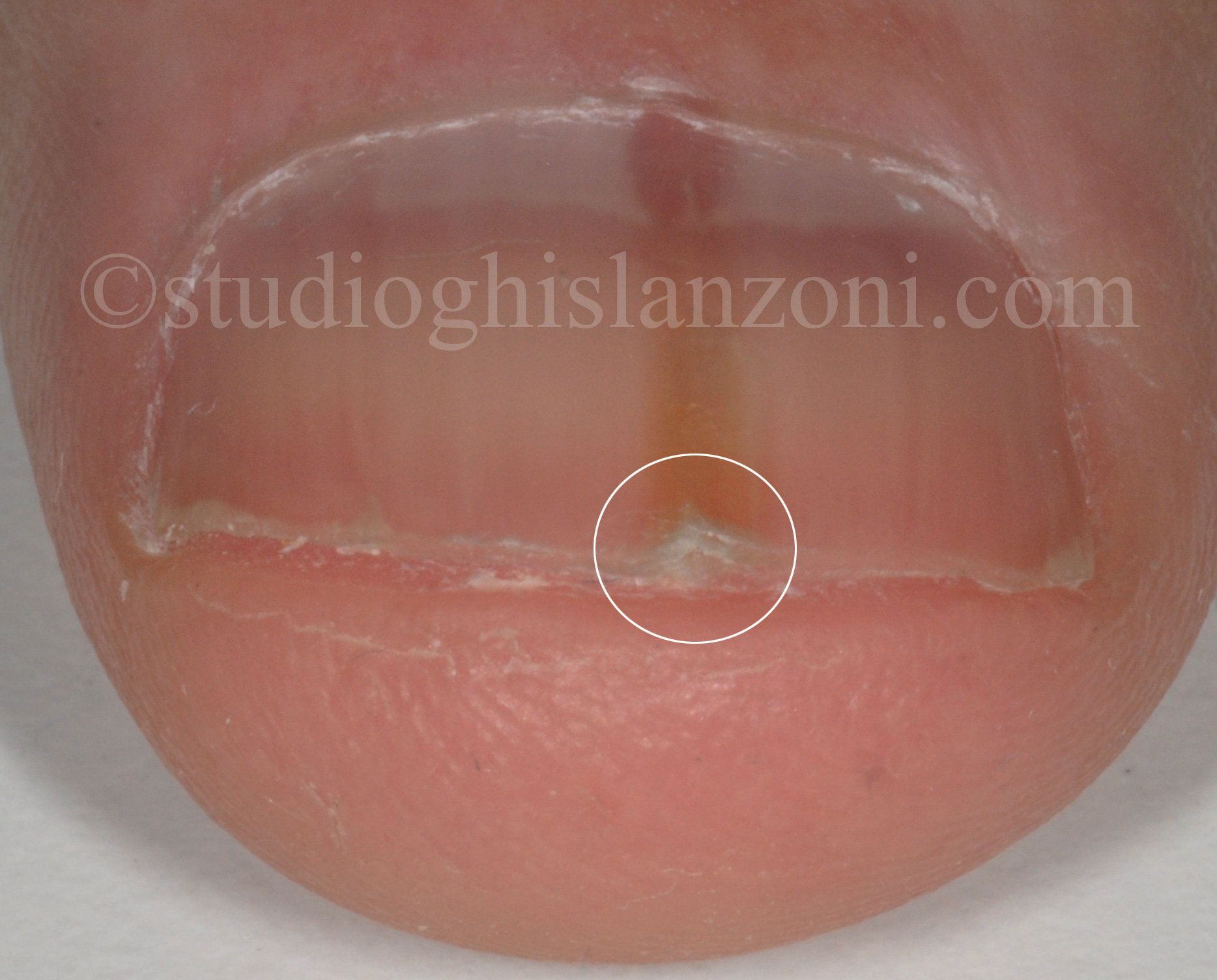 Onicopapilloma unghia mano